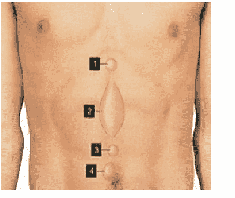 Umbilical (navel) Hernias - Bariatric Surgeon India