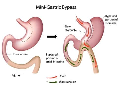 mini-gastric-bypass