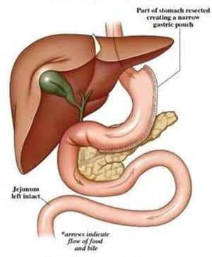 Find more about Stomach sleeve gastrectomy surgery, a laparoscopic sleeve gastrectomy procedure