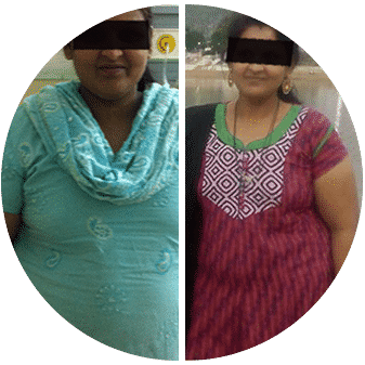 Before and after bariatric surgery in Hyderabad by Dr V Pareek, Best Bariatric Surgeon in Hyderabad.