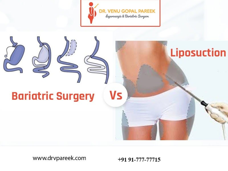 Consult Dr. Venugopal Pareek for Choose the best weight loss surgery, One of the best Bariatric surgery specialists in Hyderabad