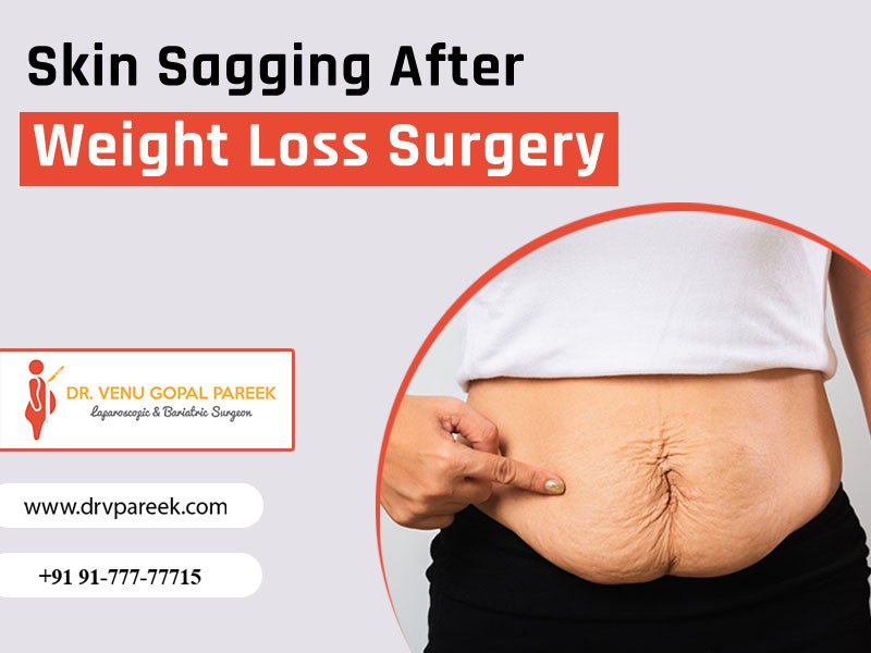 Best ways to Manage Loose Skin After Weight Loss Surgery at Bariatric surgeon India, One of the best Bariatric Surgery Hospitals in Hyderabad