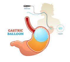 Best gastric balloon for weight loss surgery Centre in Hyderabad, Bariatric surgery specialists near me
