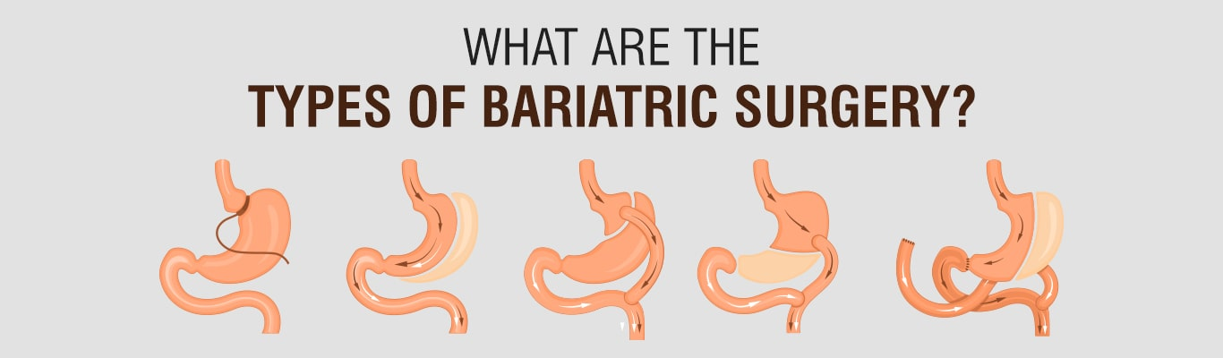 All types of Bariatric surgeries at Bariatric surgeon India, One of the best weight loss treatment specialty clinics in Hyderabad