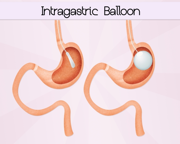 Advanced gastric balloon procedure by Dr. Venugopal Pareek, One of the best weight loss and bariatric surgeons in Hyderabad