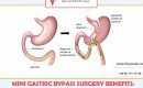 Best weight loss surgery clinic for mini Gastric bypass surgery in Hyderabad, obesity center near me