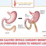 Best weight loss surgery clinic for mini Gastric bypass surgery in Hyderabad, obesity center near me