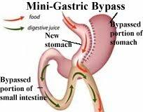 Best mini gastric bypass surgery technique in Hyderabad, weight loss management clinic near me