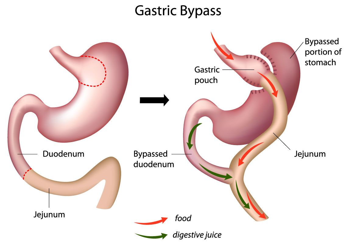 Best Gastric bypass surgery for weight loss by Dr. Venugopal Pareek, One of the best Bariatric Surgeons in Hyderabad
