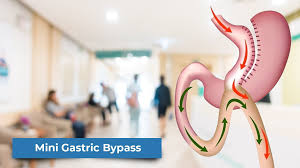Know the benefits of mini Gastric bypass surgery for weight loss at Bariatric surgeon India, One of the best centers for overweight in Hyderabad