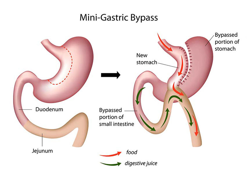 Best Mini gastric bypass surgery for weight loss by Dr. Venugopal Pareek, One of the best Bariatric doctors in Hyderabad