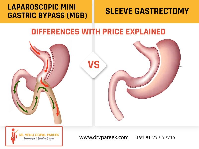 Best Laparoscopic Mini Gastric Bypass and Sleeve Gastrectomy in Hyderabad, natural weight loss center near me