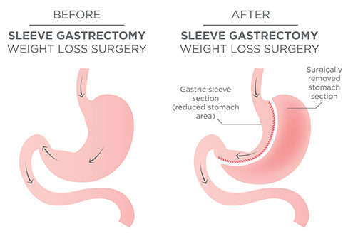 long-term results of laparoscopic sleeve gastrectomy for obesity at Bariatric surgeon India clinic, One of the best weight loss surgery Clinics in Hyderabad