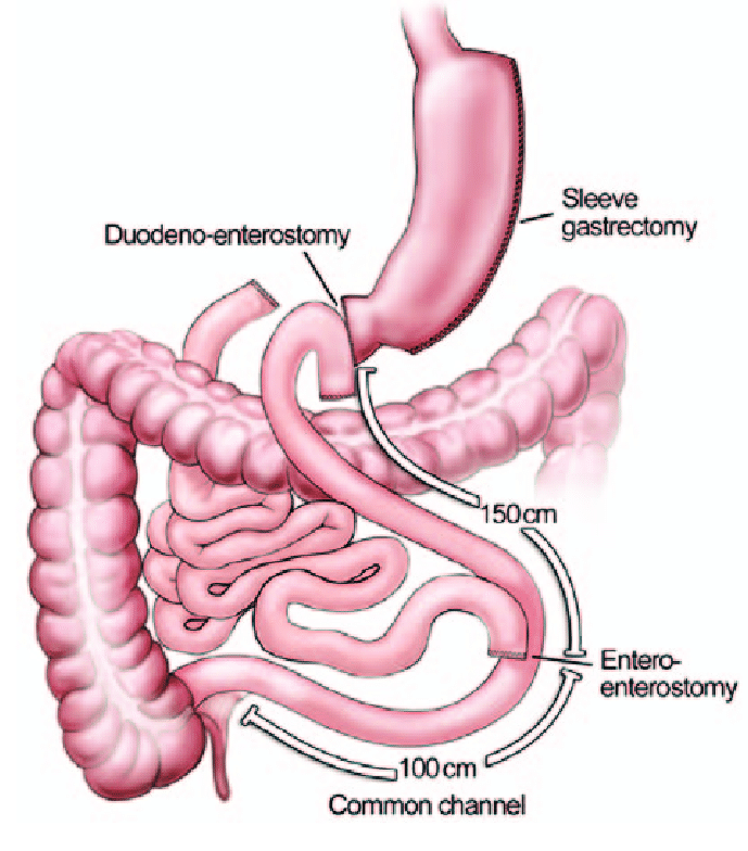 Biliopancreatic Diversion with Duodenal Switch (BPD / DS) type of weight loss surgery in Hyderabad, Bariatric surgery hospital near me