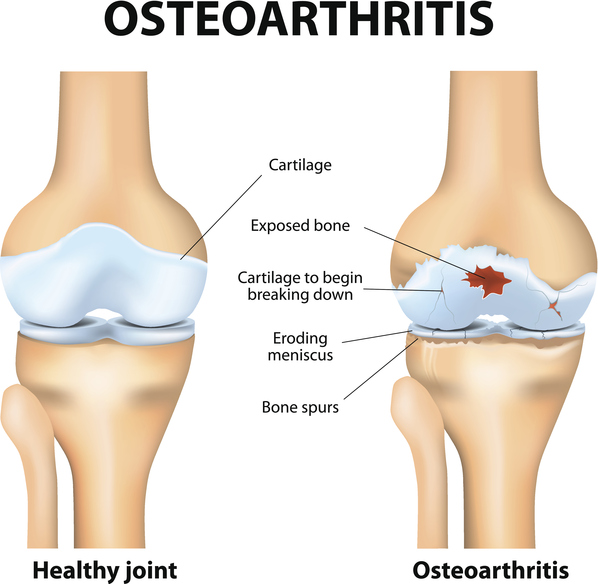 Overweight harm your knees with osteoarthritis and its treatment at a Bariatric surgeon India