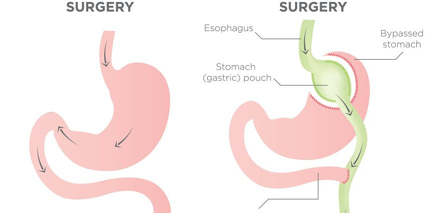 Cost of laparoscopic mini-gastric bypass surgery and Sleeve gastrectomy in Hyderabad, Bariatric surgery hospital near me