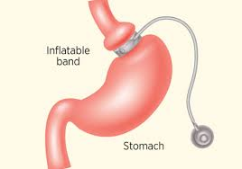 Adjustable gastric band for Weight loss surgery in Hyderabad, weight decrease doctors near me