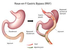 Laparoscopic RNY Gastric Bypass in Hyderabad, weight loss surgery clinic near me
