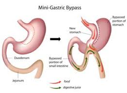 Best Mini Gastric bypass surgery for weight loss in Hyderabad, Bariatric medical center near me