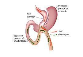 Laparoscopic Mini Gastric Bypass surgery in Hyderabad, weight reduction clinic near me