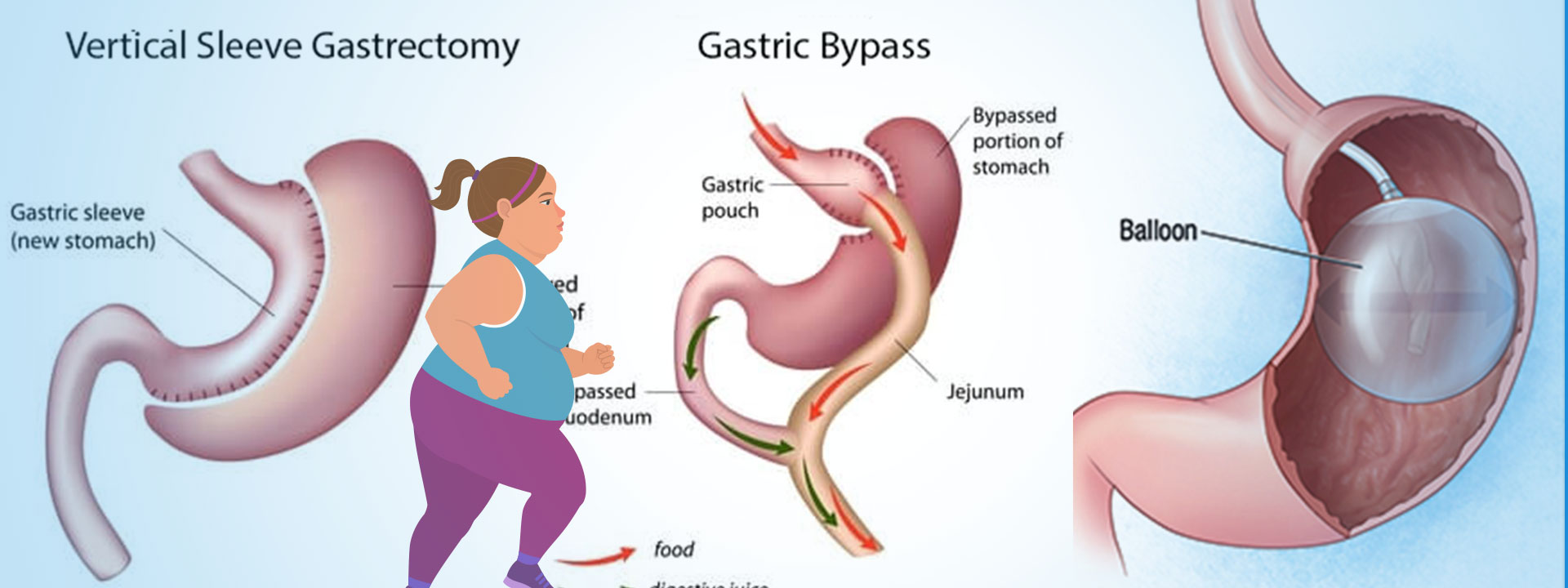 Different types of weight loss surgeries at Bariatric surgeon India, One of the best center for weight decrease surgery in Hyderabad