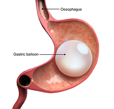 Intragastric Balloon or Gastric Balloon Placement for Weight loss in Hyderabad, weight reduction surgery hospital near me