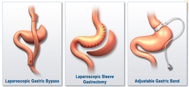 All types Baritric surgeries done at Bariatric surgeon India, best laparoscopic weight lose surgery centers in Hyderabad