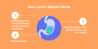You Need to Know About Gastric Balloon Procedure at Bariatric surgeon India, One of the best weight reduction surgery centers in Hyderabad