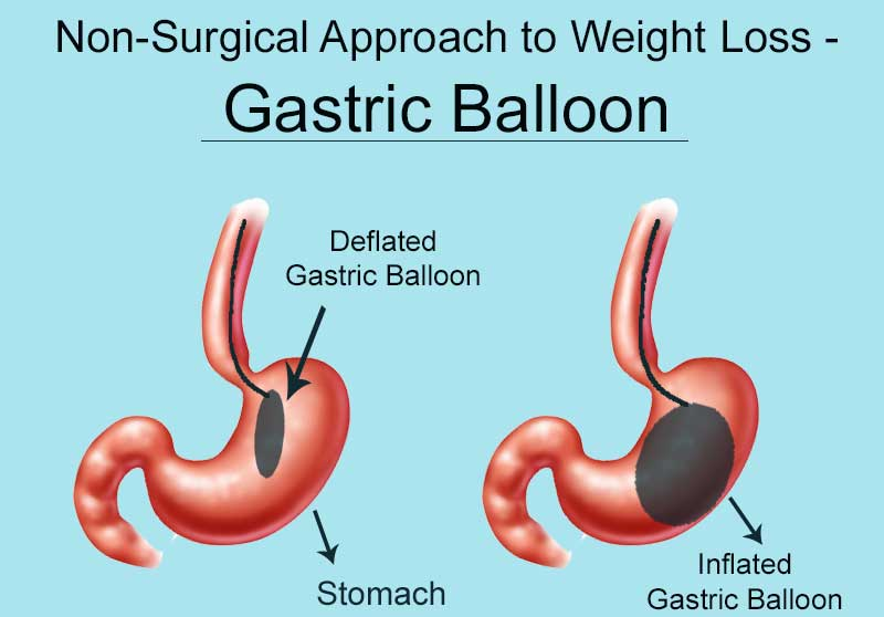 Gastric Balloon for Non-Surgical Weight loss at Baritric surgeon India, One of the the best center for Weight reduction in Hyderabad