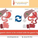 Gastric bypass surgery for weight reduction in Hyderabad, weight loss treatment near me