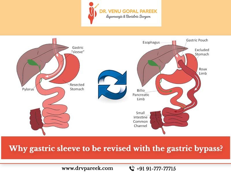 Gastric bypass surgery for weight reduction in Hyderabad, weight loss treatment near me