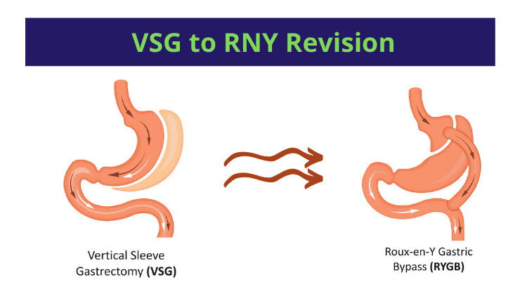 Consult Dr. Venugopal Pareek for Vertical sleeve revision and RNY Gastric bypass surgery, weight loss surgery doctor near me