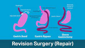 Contact Dr. Venugopal Pareek for Vertical Sleeve Revision to Gastric Bypass, one of the best Bariatric Surgeons in Hyderabad