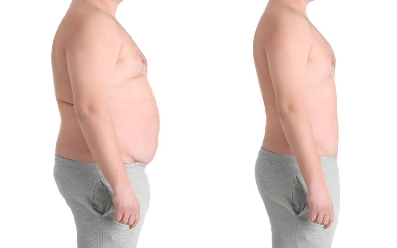 100 Percent result-oriented Bariatric surgery in Hyderabad, weight loss surgery specialists near me