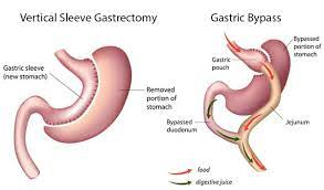 Meet Dr. Venugopal Pareek to Choose best one for weight loss from Vertical sleeve gastrectomy and Gastric bypass, one of the best Bariatric Surgery specialists in Hyderabad