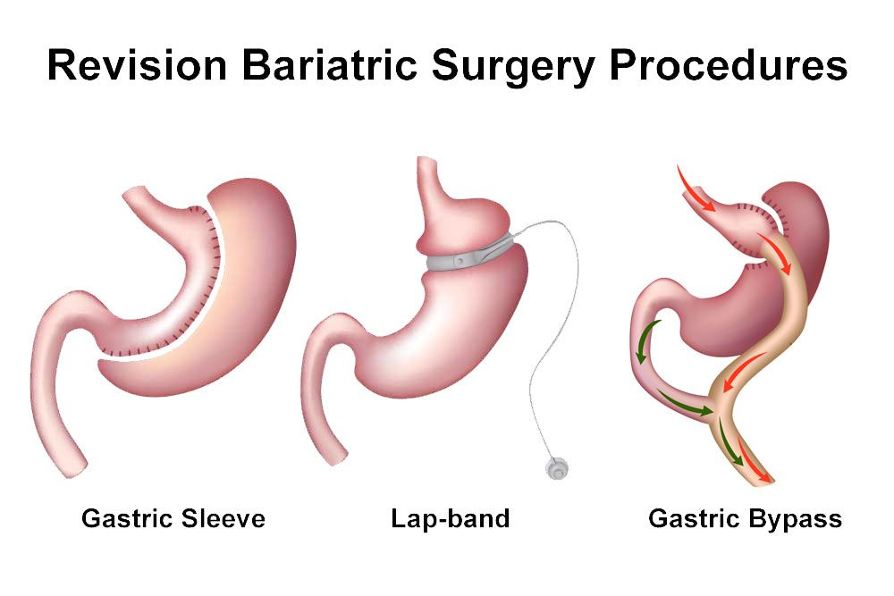 Result of Revision vertical sleeve to gastric bypass at Bariatric surgeon India, One of the best weight loss surgery clinics in Hyderabad