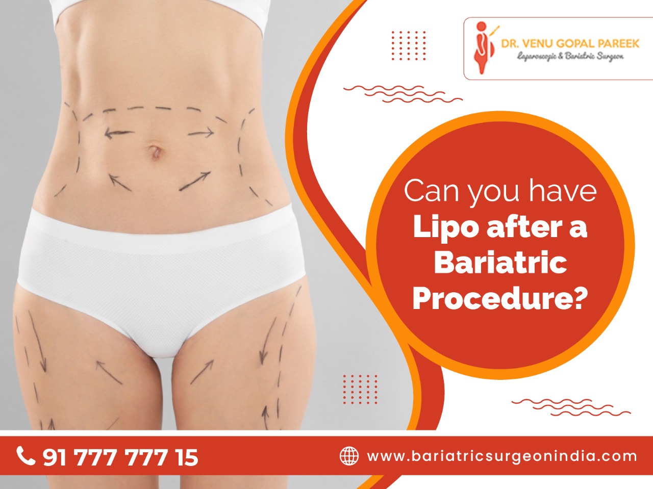Bariatric Surgery Vs. Liposuction - Bariatric Surgeon India