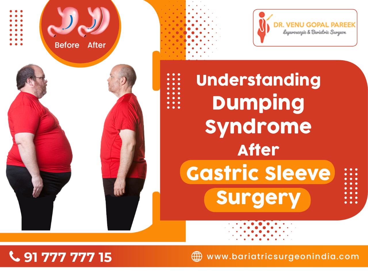understanding dumping syndrome after gastric sleeve surgery