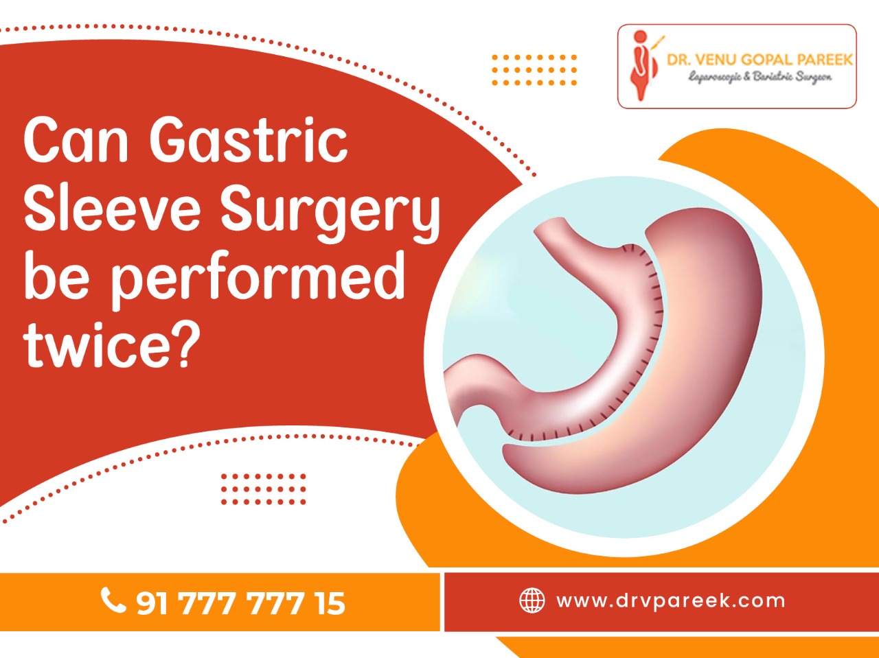 can gastric sleeve surgery be performed twice